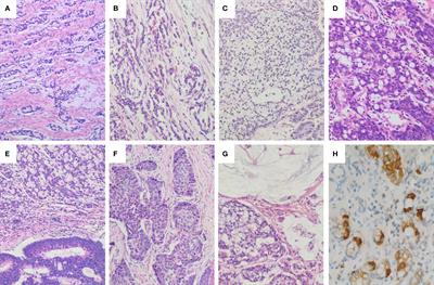 Gastrointestinal Goblet Cell Adenocarcinomas Harbor Distinctive Clinicopathological, Immune, and Genomic Landscape